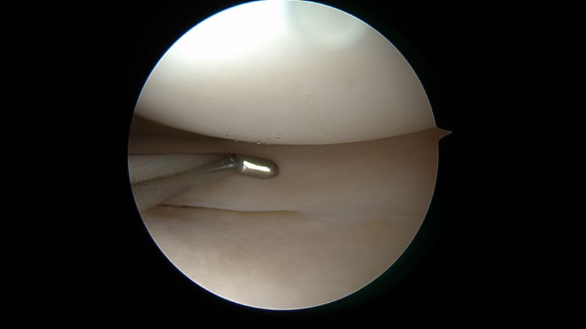 Arthroskop im Einsatz