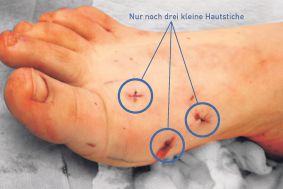 Die OP wird über drei kleine Hautstiche durchgeführt.